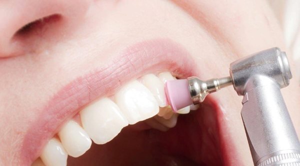 Full Mouth dental implants