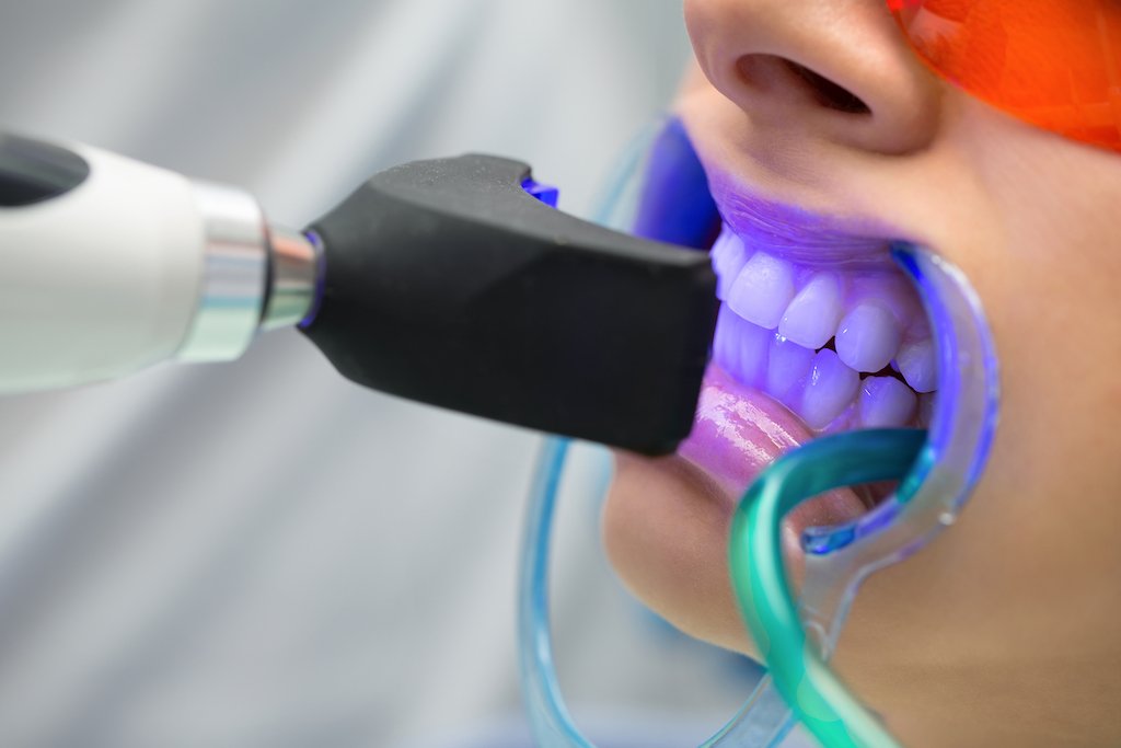 Full Mouth dental implants
